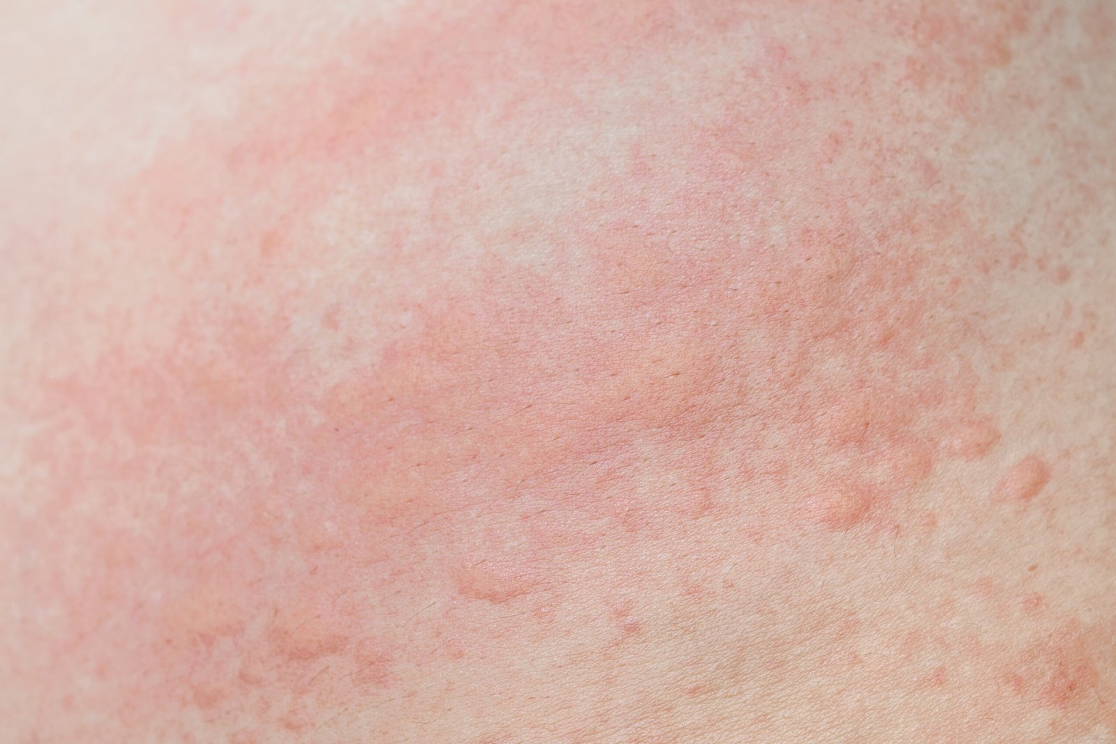 Allergic skin rash prickly heat skin red dot closeup skin problem itching Skingroup | Dermatólogos en Monterrey