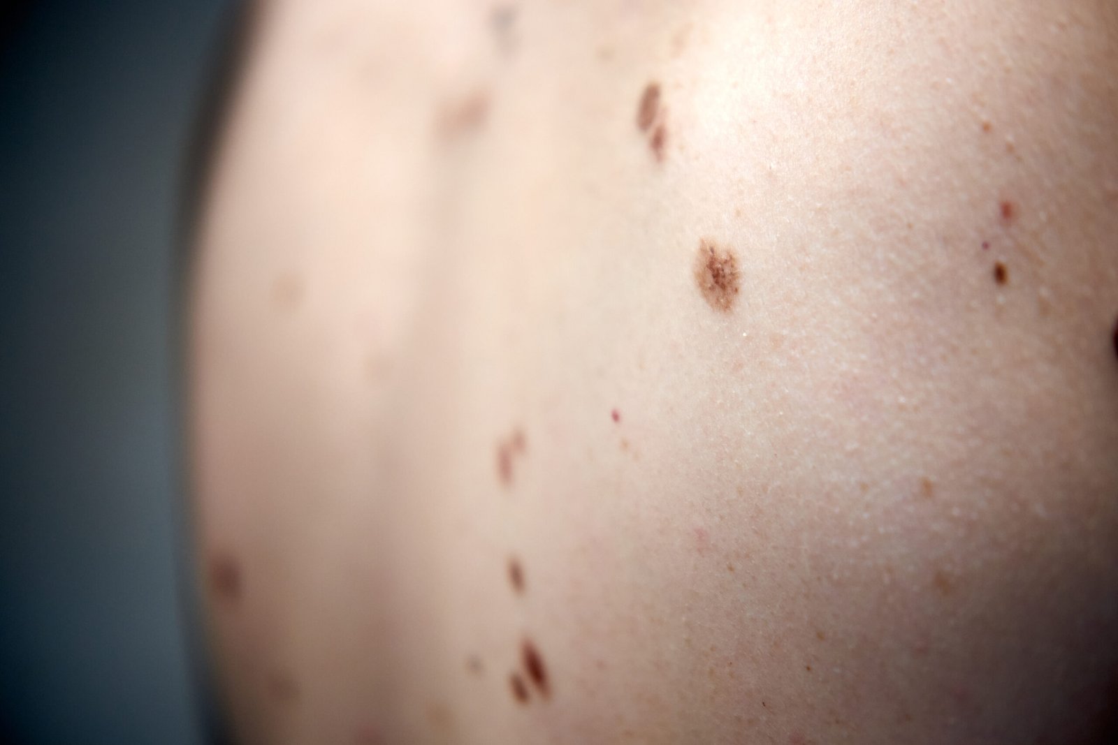 Middle-aged,Hispanic,Man,Examines,The,Size,,Color,And,Shape,Of Skingroup | Dermatólogos en Monterrey