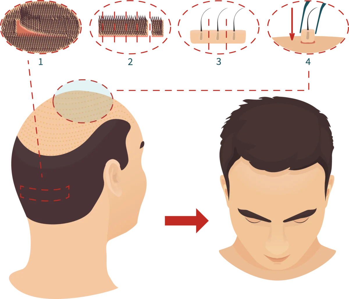 trasplante-1200×1031.png Skingroup | Dermatólogos en Monterrey