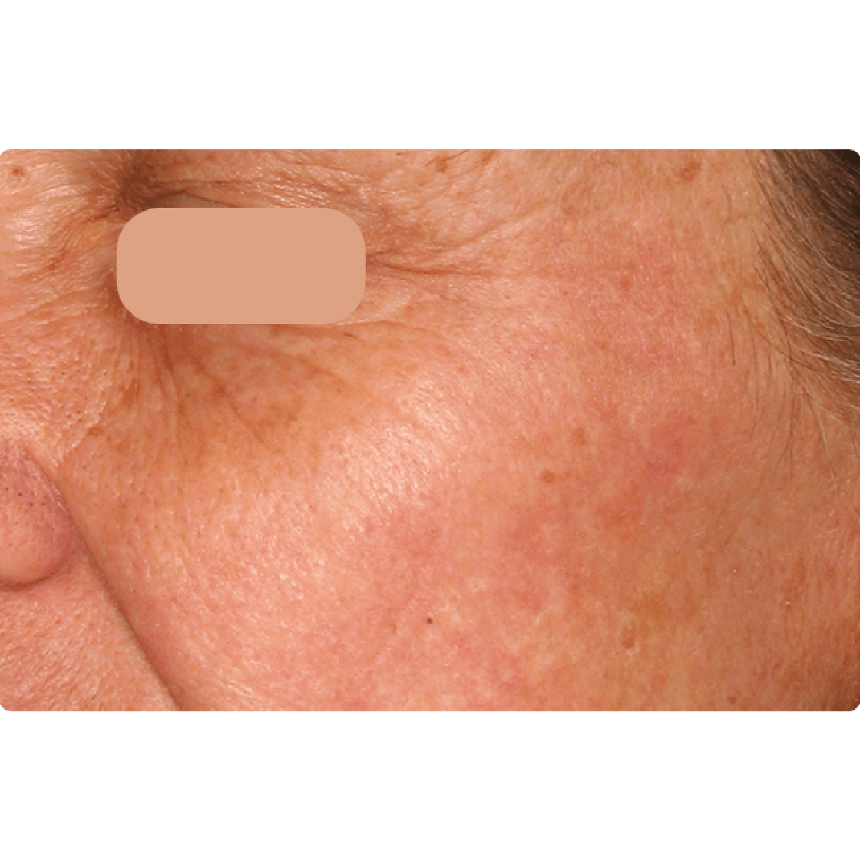 AcuPulse | AcuPulse | Skingroup | Dermatólogos en Monterrey Zona Sur |