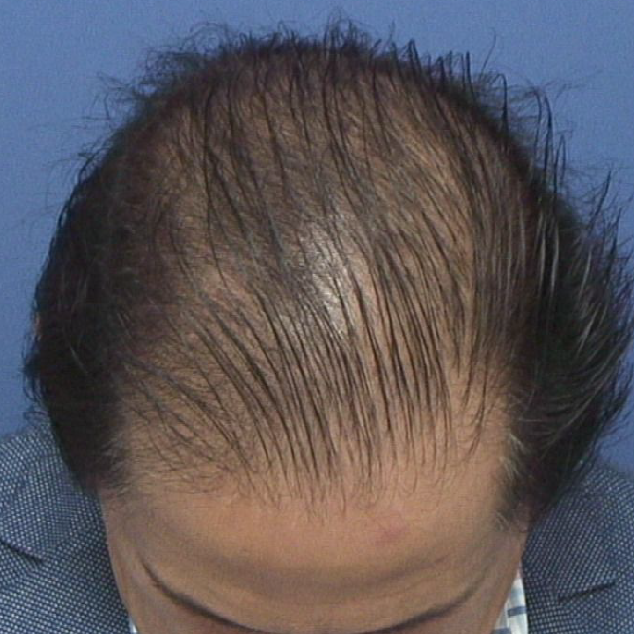 Injerto de pelo | Skingroup | Dermatólogos en Monterrey Zona Sur