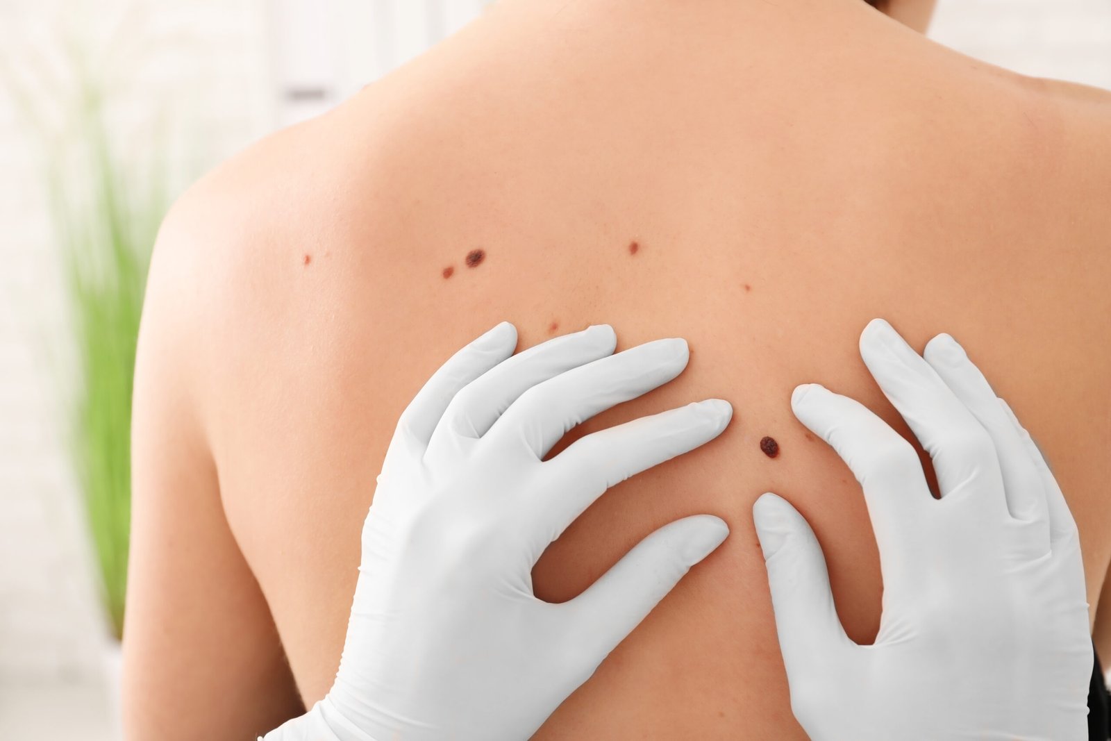 Cáncer de piel | Skingroup | Dermatólogs en México