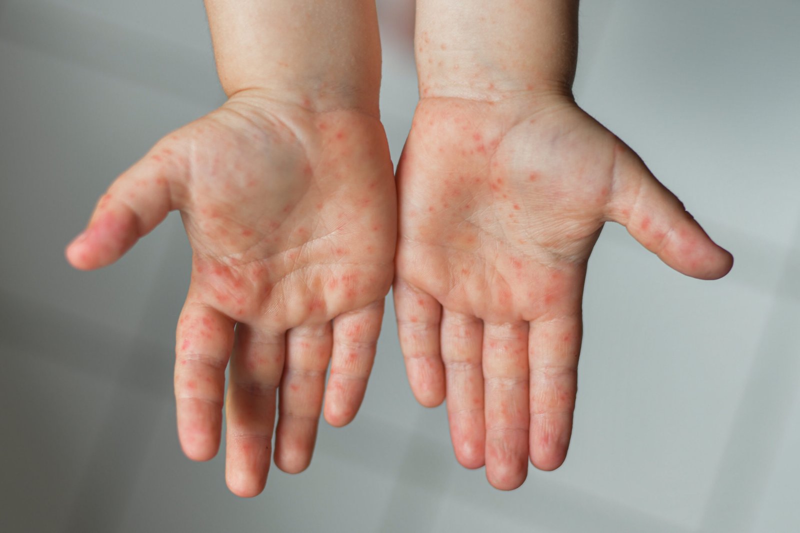 Enterovirus Leg arm mouth Rash on the body of a child Cocksackie virus Skingroup | Dermatólogos en Monterrey