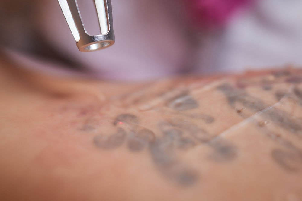 Young woman undergoing laser tattoo removal procedure in salon, closeup. Skingroup | Dermatólogos en Monterrey