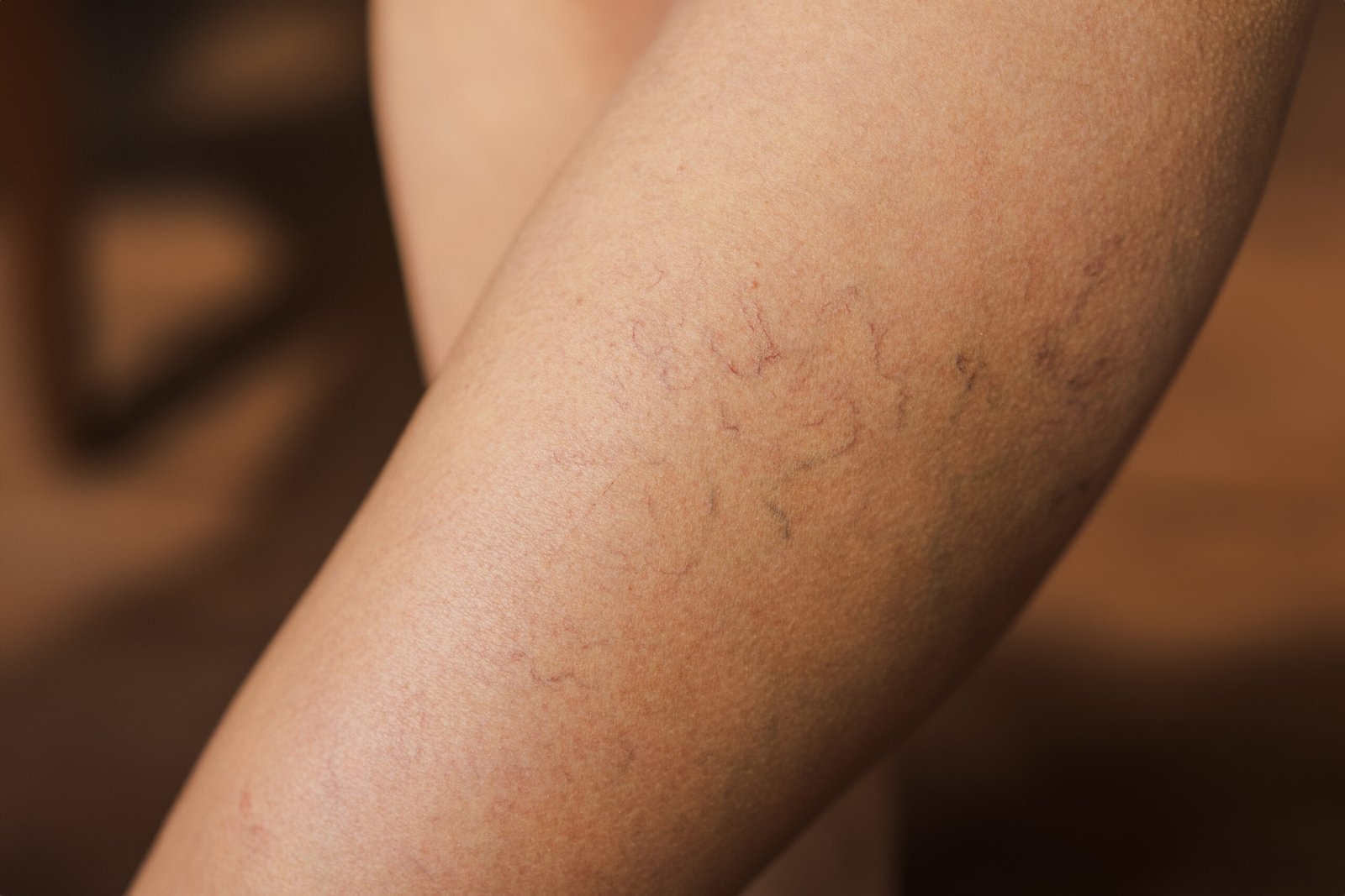 Varicose veins of small vessels on the skin of a woman’s thigh. Skingroup | Dermatólogos en Monterrey