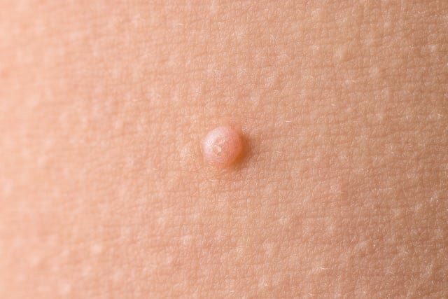 11_MOLUSCO Skingroup | Dermatólogos en Monterrey