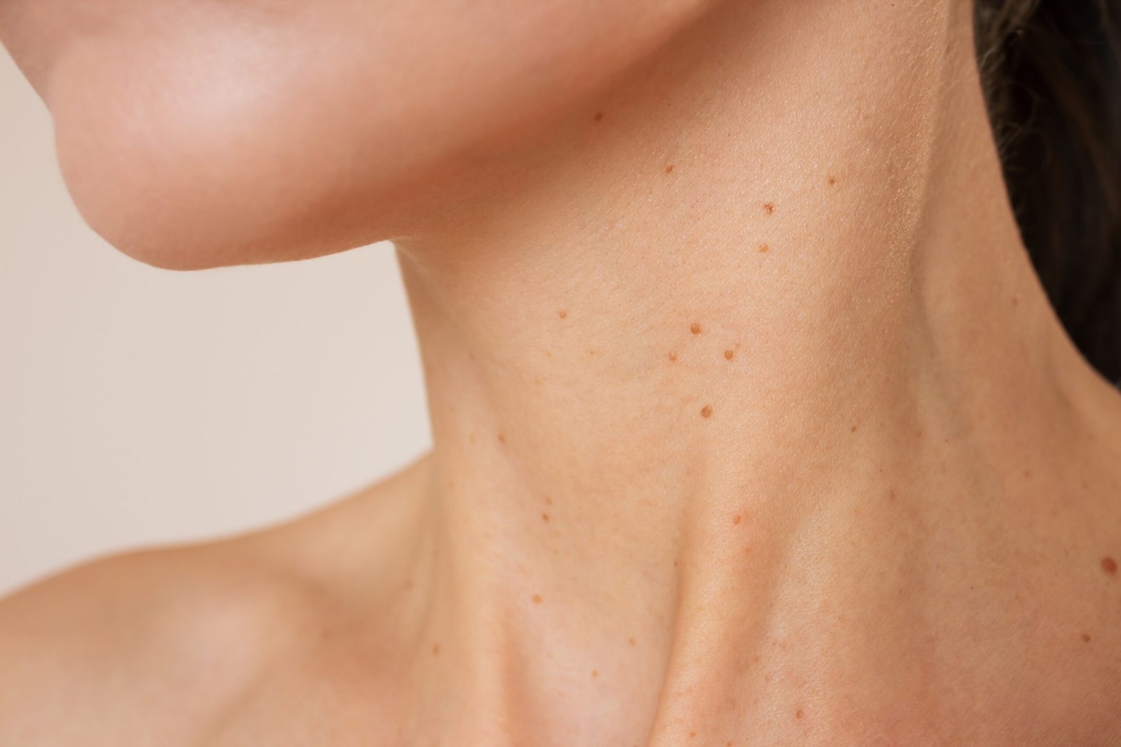 14_VERRUGASCUELLO Skingroup | Dermatólogos en Monterrey