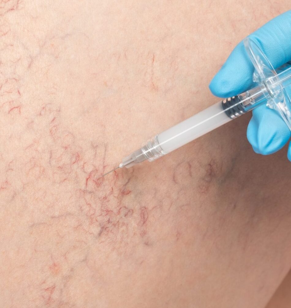 Removal,Of,Varicose,Veins,On,The,Legs.,Medical,Inspection,And Skingroup | Dermatólogos en Monterrey