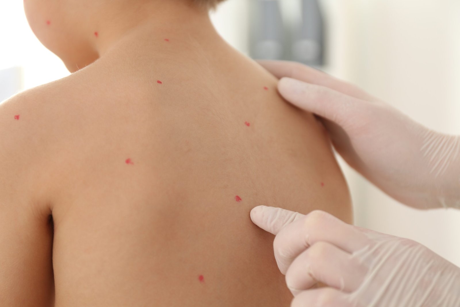 Doctor,Examining,Little,Boy,With,Chickenpox,In,Clinic,,Closeup.,Varicella