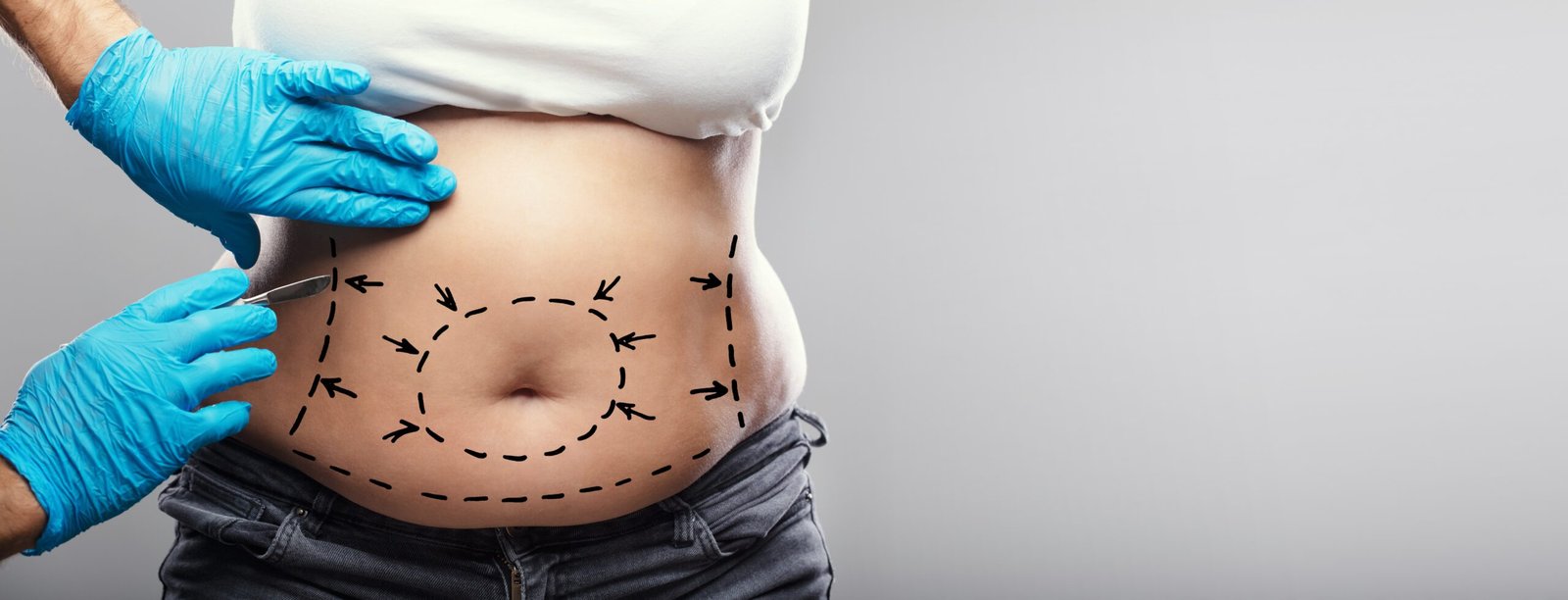 Liposuction,Abdominoplasty,Plastic,Surgery.,Surgeon,Holding,Scalpel Skingroup | Dermatólogos en Monterrey