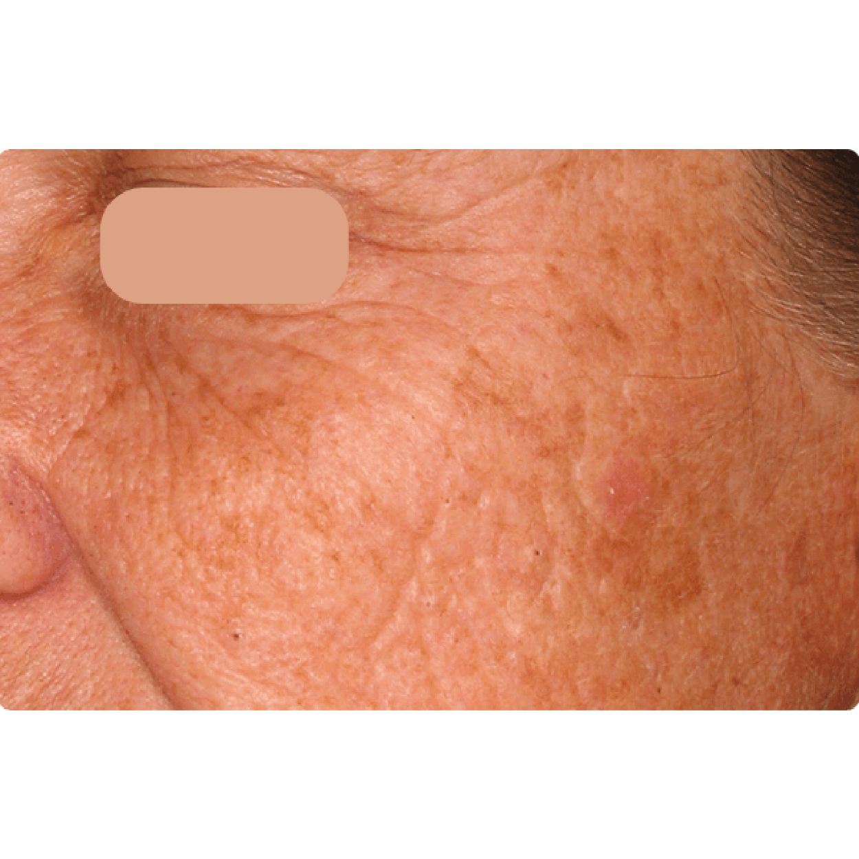 AcuPulse | AcuPulse | Skingroup | Dermatólogos en Chihuahua |