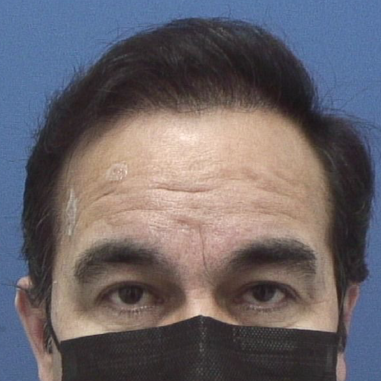 Injerto de pelo | Skingroup | Dermatólogos en Chihuahua