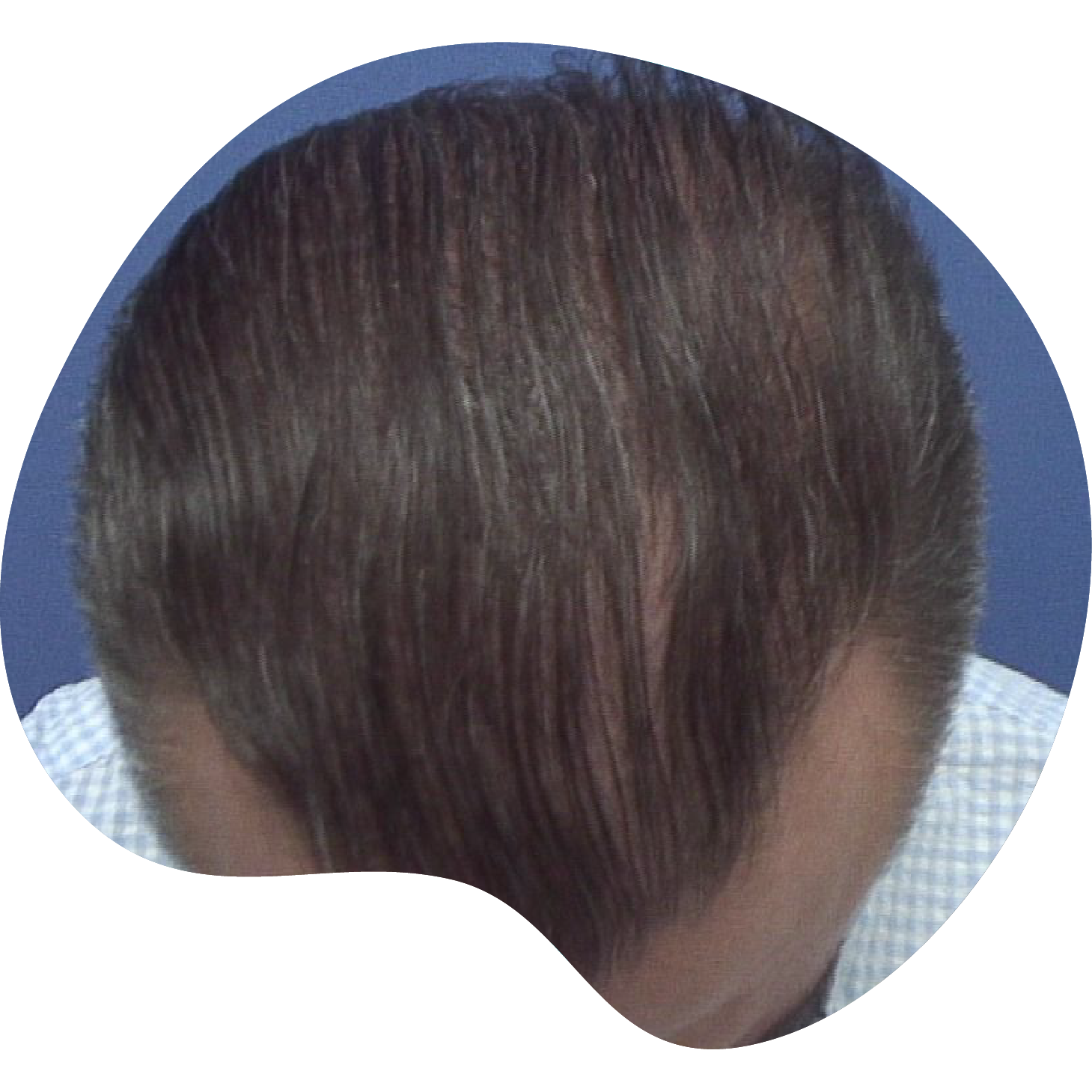 Injerto de pelo | Skingroup | Dermatólogos en Chihuahua