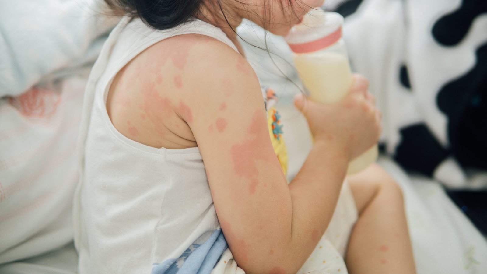 Alergias cutáneas infantiles | Skingroup