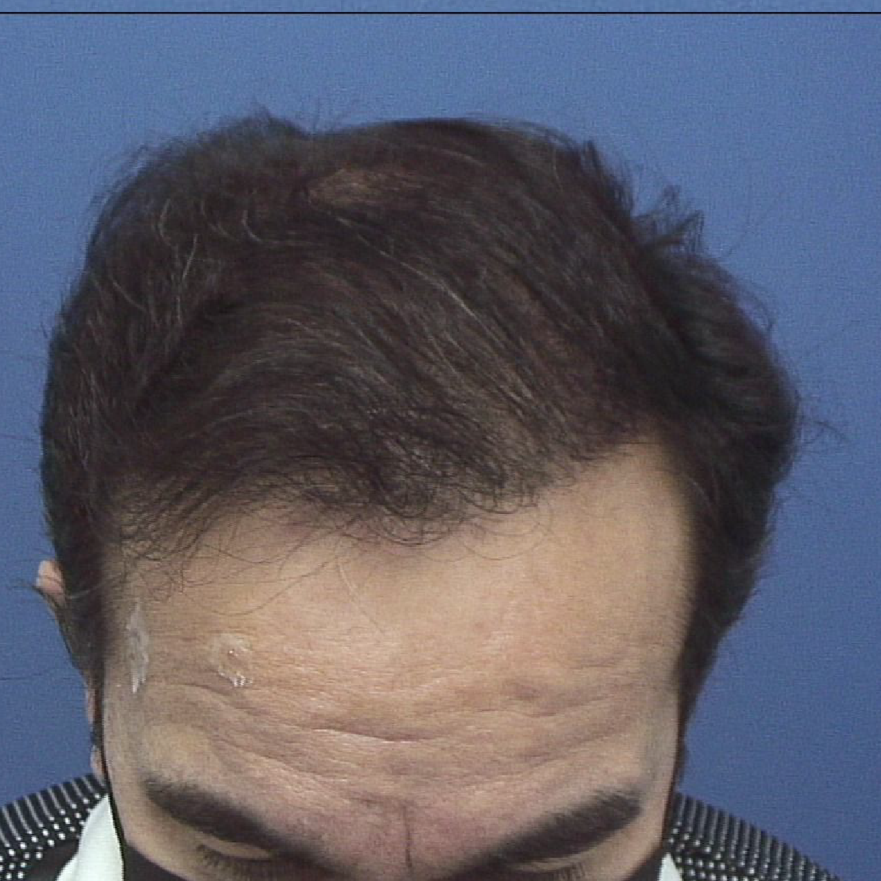 Injerto de pelo | Skingroup | Dermatólogos en CDMX