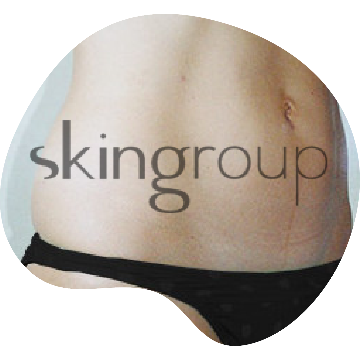 Liposucción en Monterrey | Skingroup | Dermatólogs en México