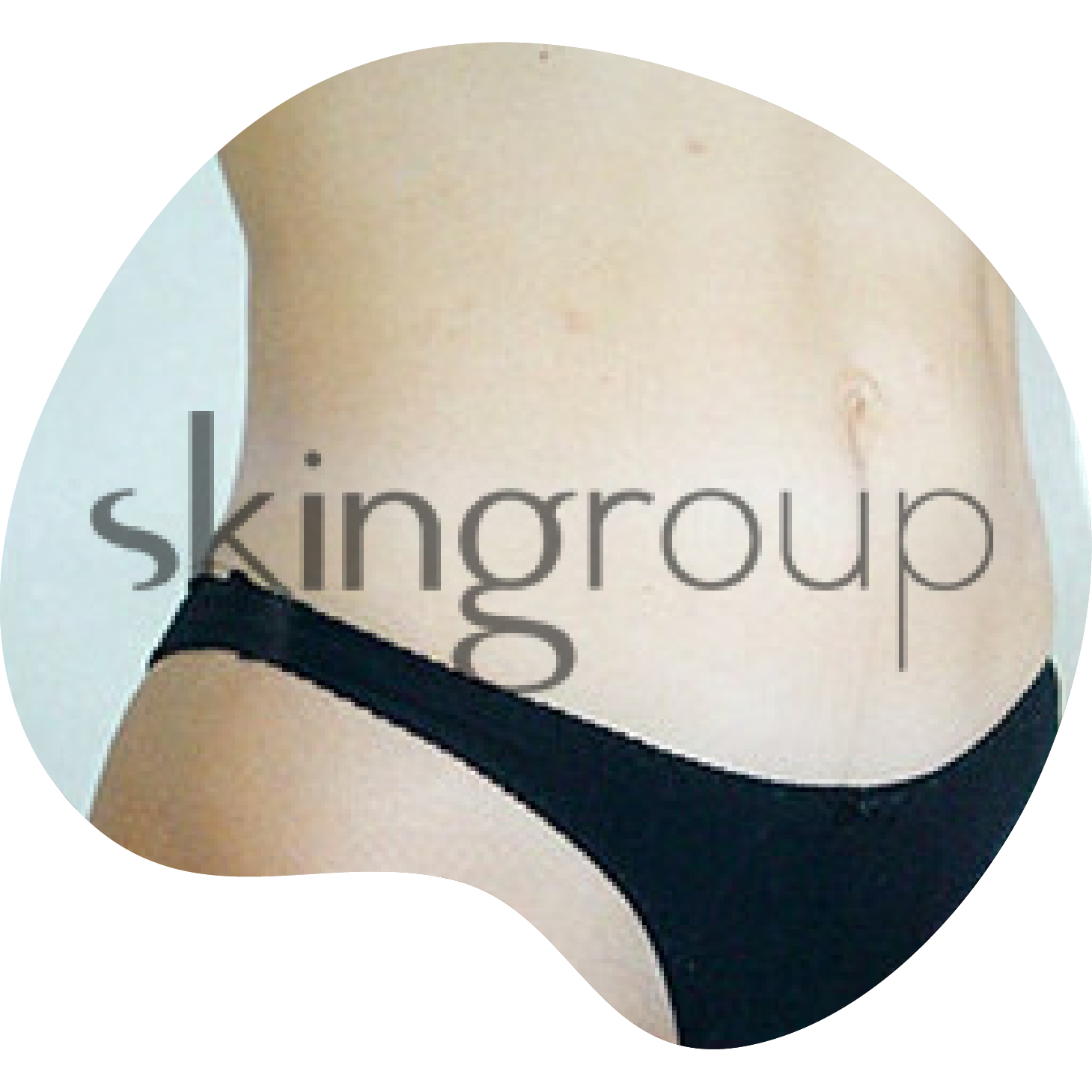 Liposucción en Monterrey | Skingroup | Dermatólogs en México