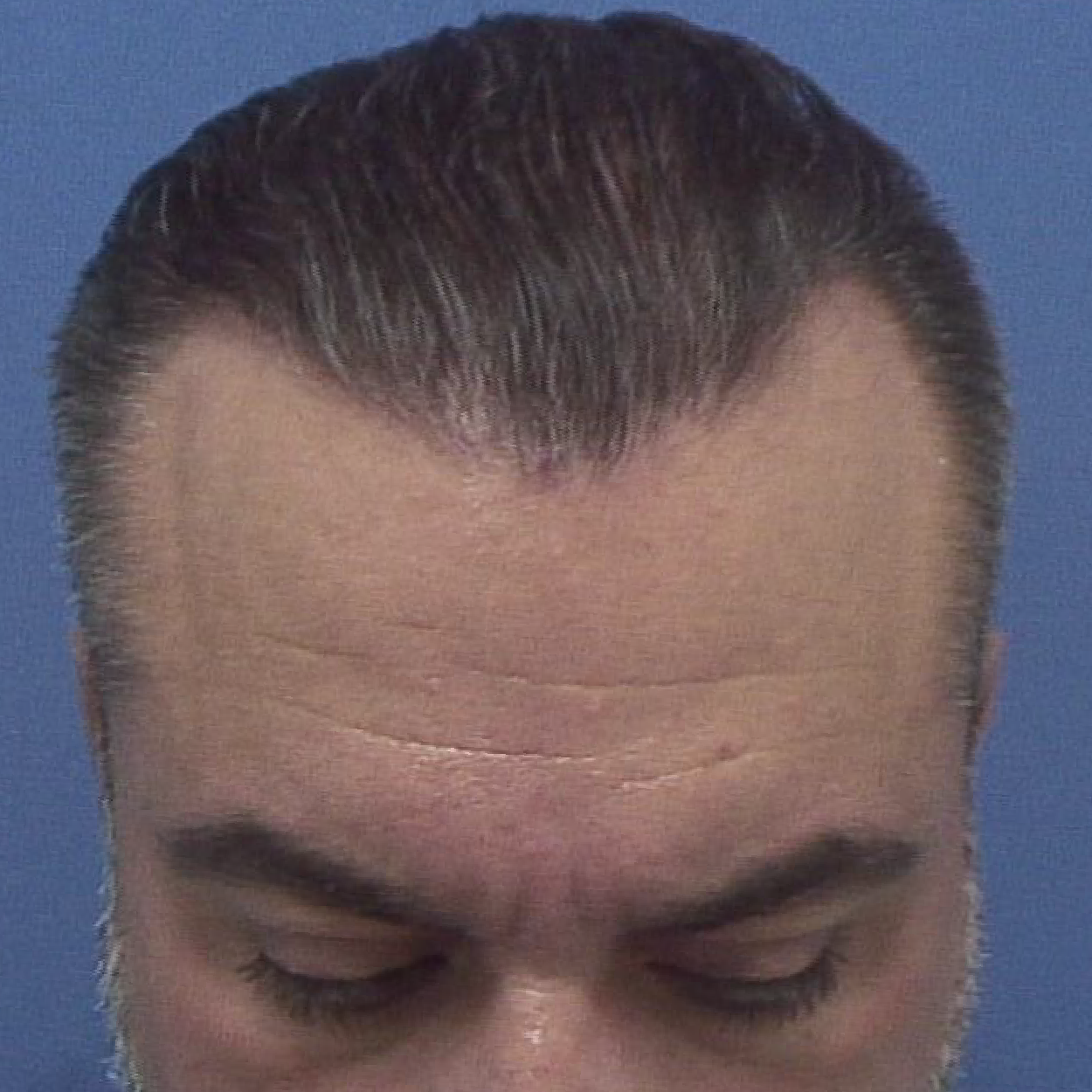 Injerto de pelo | Skingroup | Dermatólogos en Cumbres
