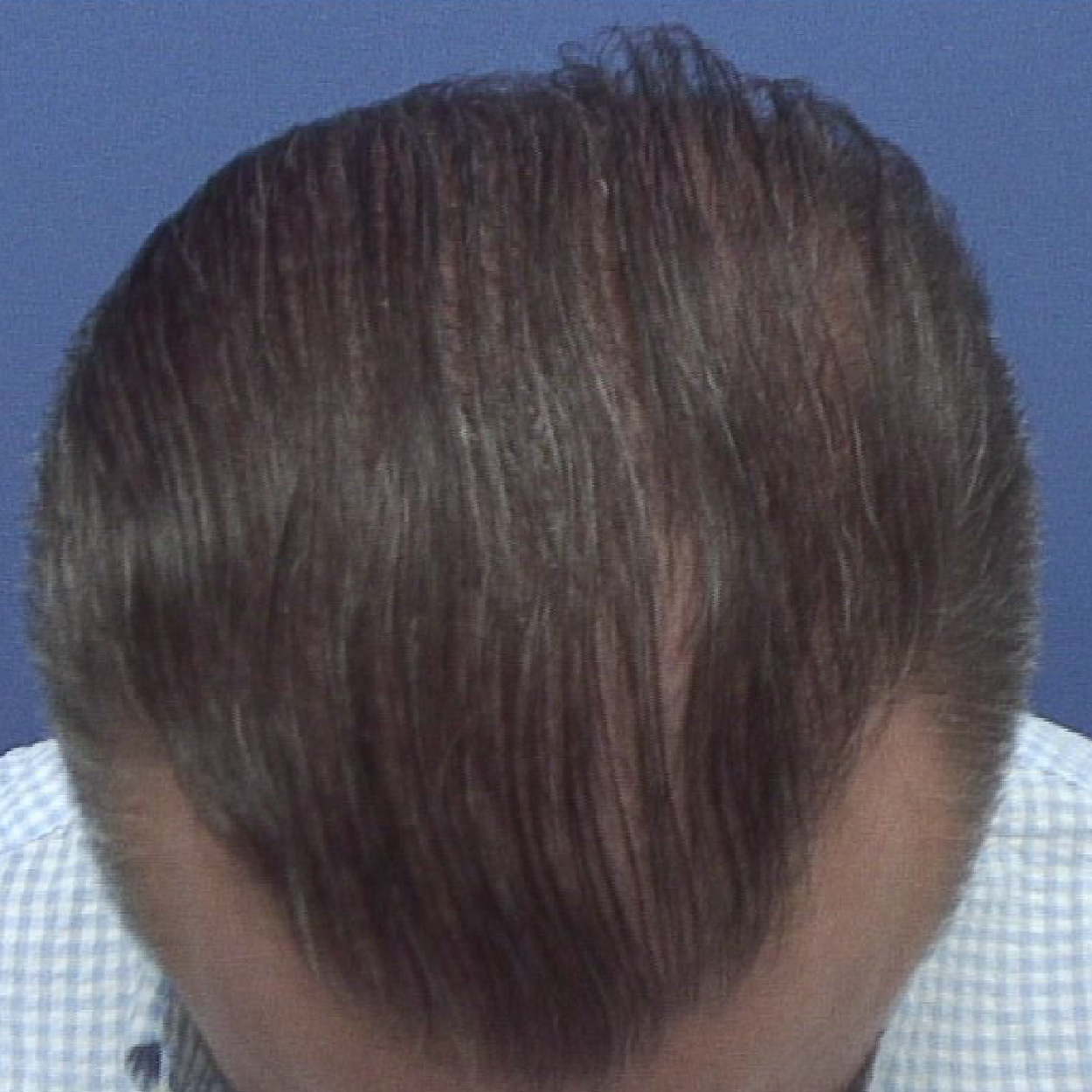 Injerto de pelo | Skingroup | Dermatólogos en Cumbres