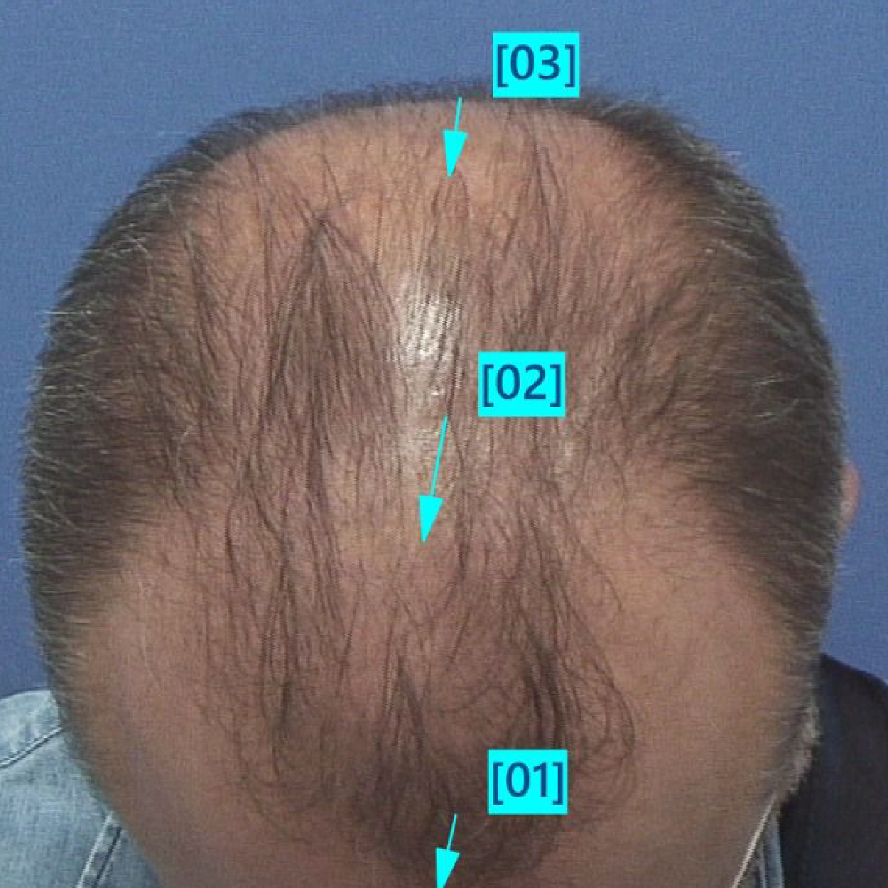 Injerto de pelo | Skingroup | Dermatólogos en Cumbres