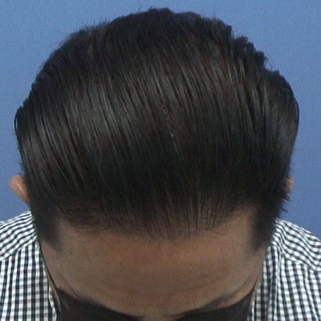 Injerto de pelo | Skingroup | Dermatólogos en Cumbres