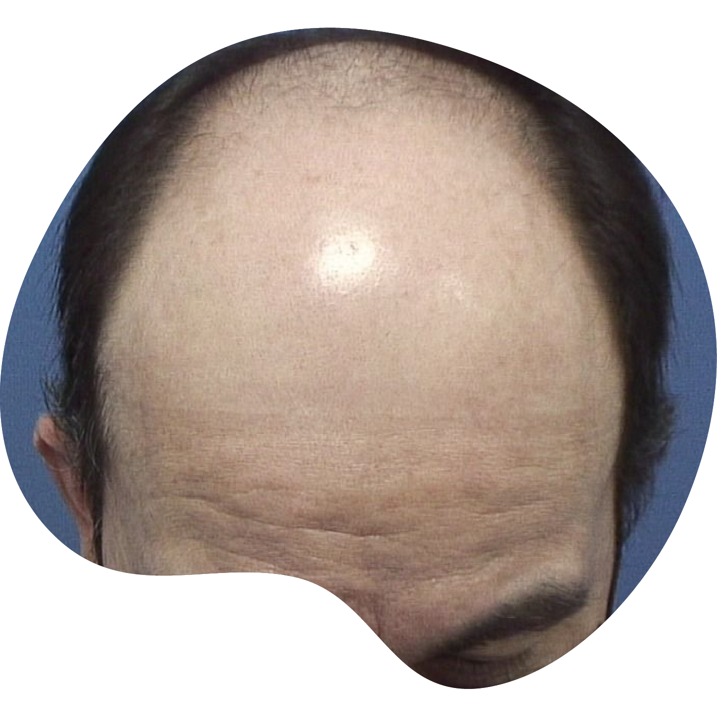 Injerto de pelo | Skingroup | Dermatólogs en México