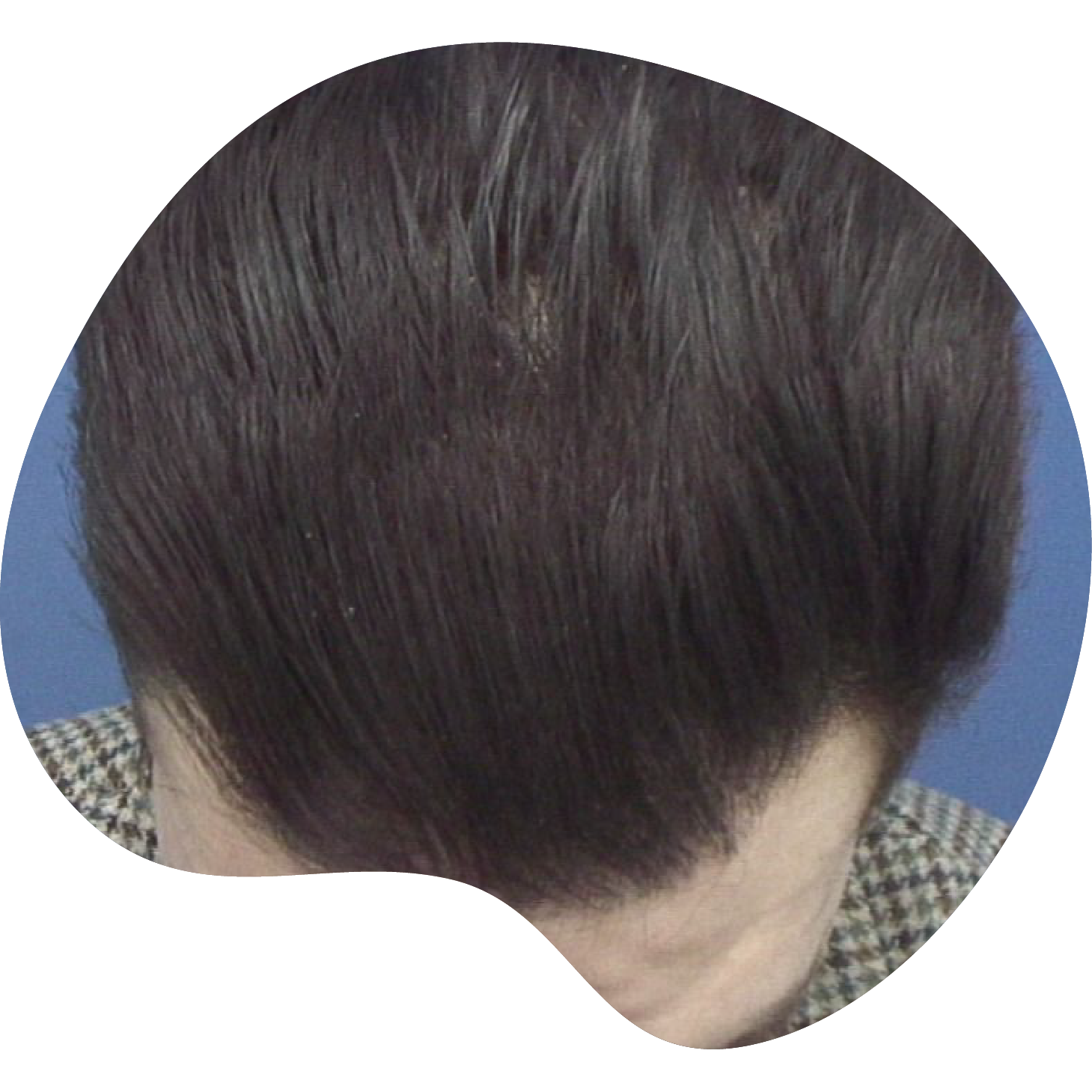 Injerto de pelo | Skingroup | Dermatólogs en México