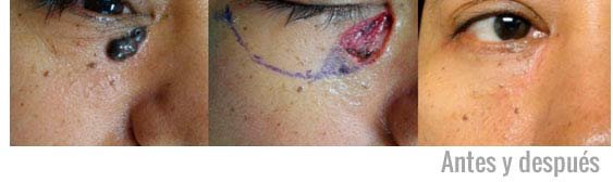 caso-resuelto-de-cancer-de-piel