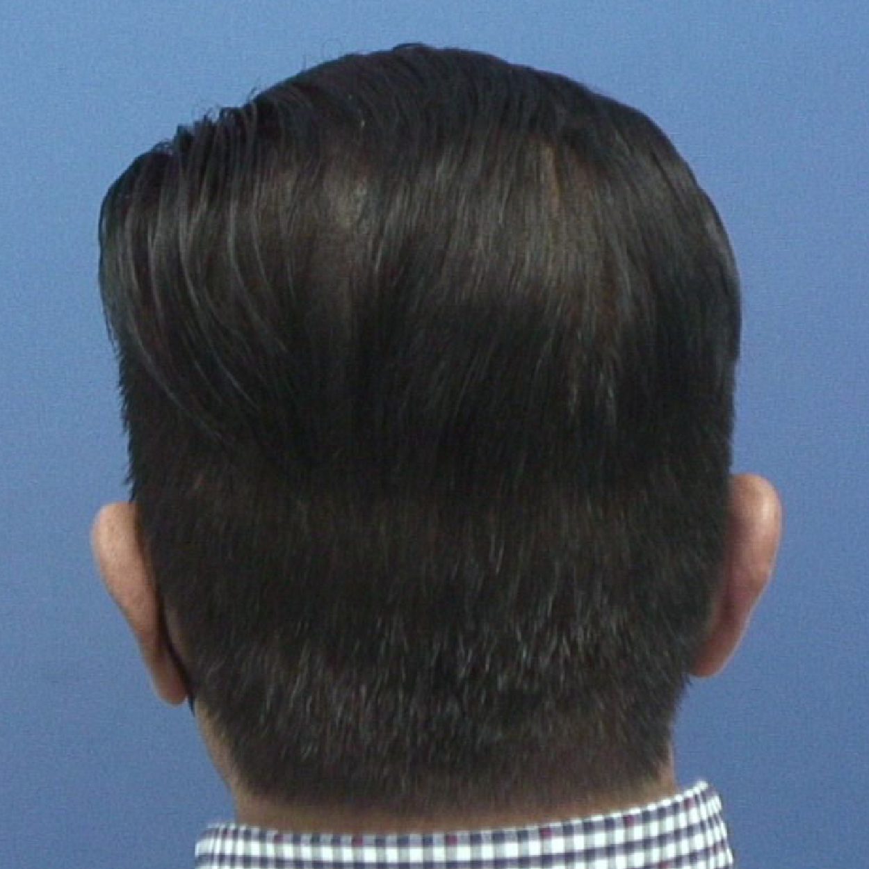 Injerto de pelo | Skingroup | Dermatólogos en Querétaro