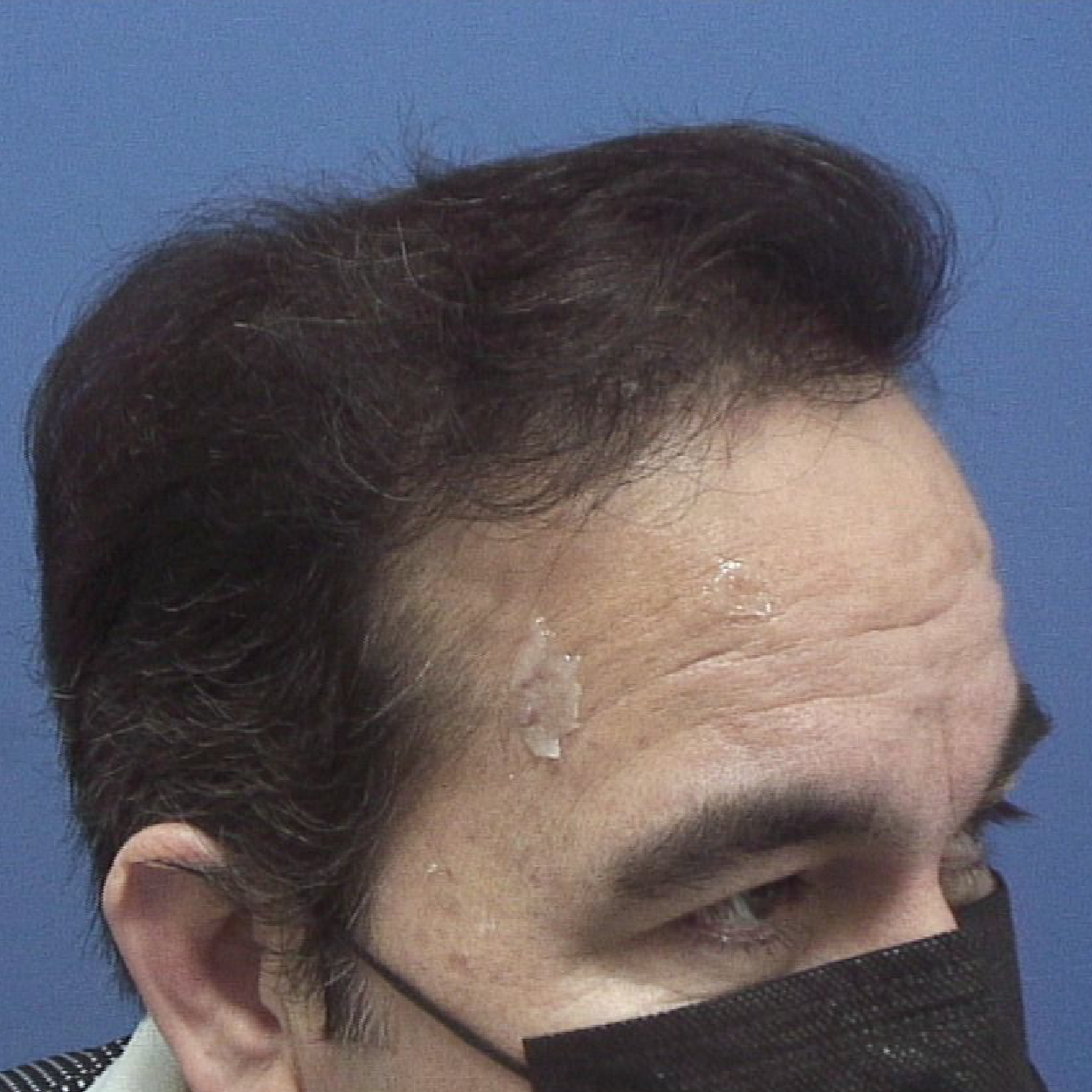 Injerto de pelo | Skingroup | Dermatólogos en Querétaro