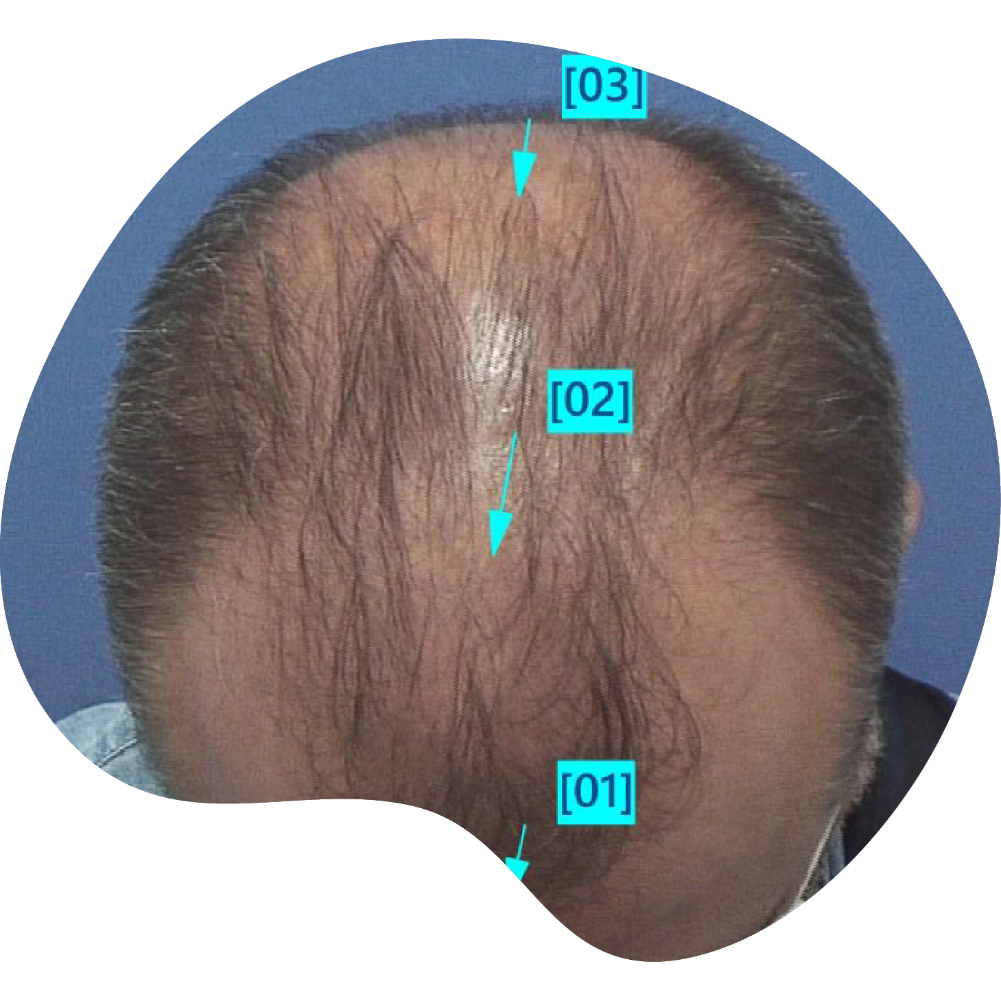 Injerto de pelo | Skingroup | Dermatólogos en México