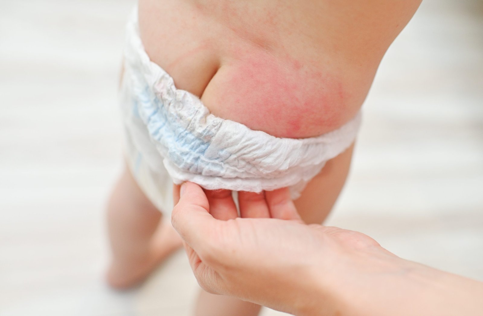 Dermatitis del Pañal | Skingroup