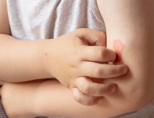 Dermatitis en Niños: Identificación y Tratamiento Efectivo