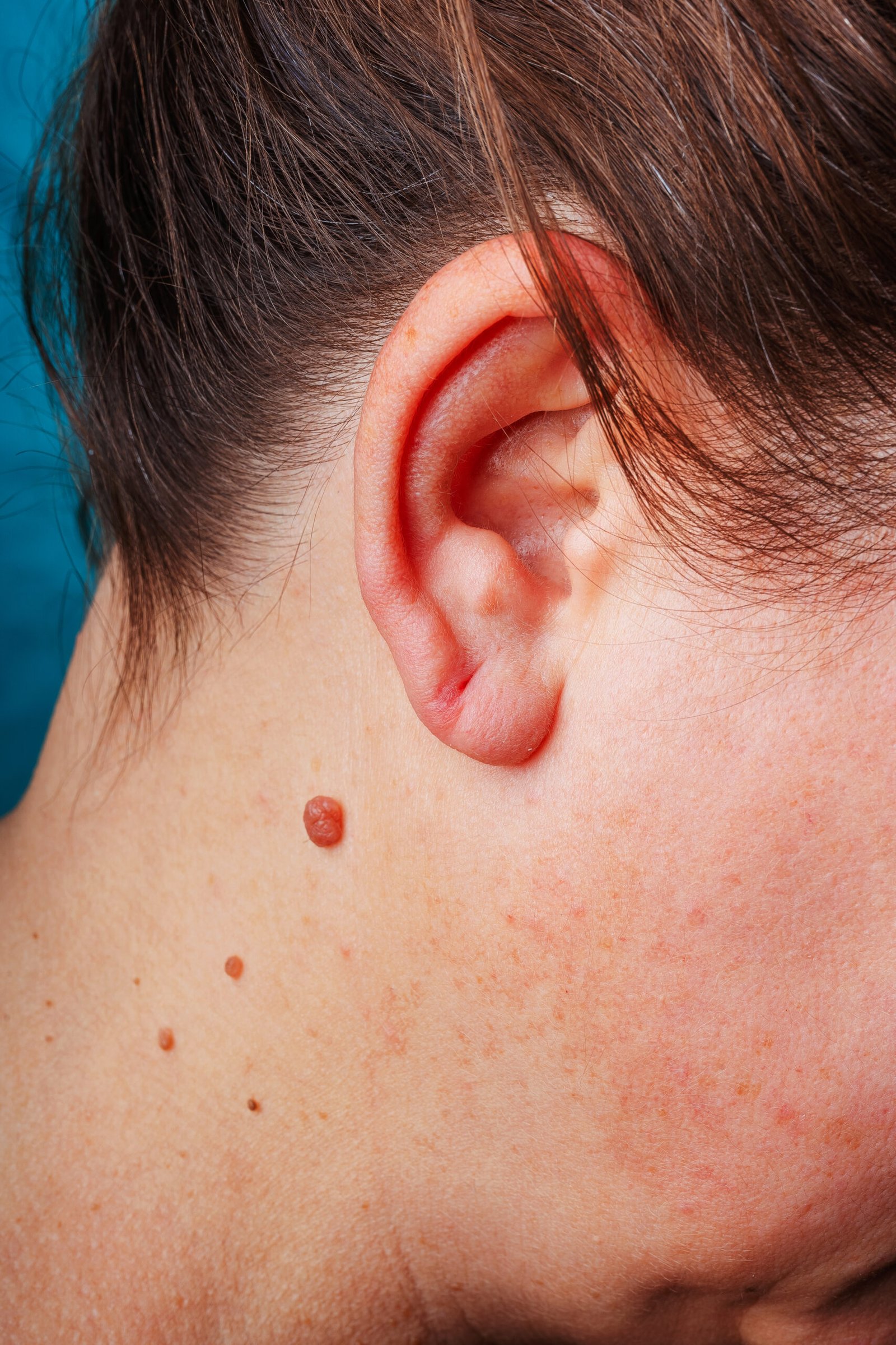 Large,Mole,Near,The,Ear,Close-up.,A,Red,Mole,On