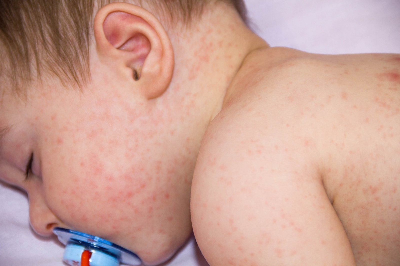 Baby,Allergy,Skin,Food.,Child,Dermatitis,Symptom,Problem,Rash.,Face
