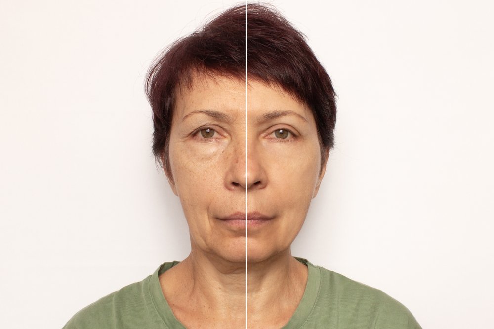 Close-up,Of,An,Elderly,Woman’s,Face,Before,And,After,A
