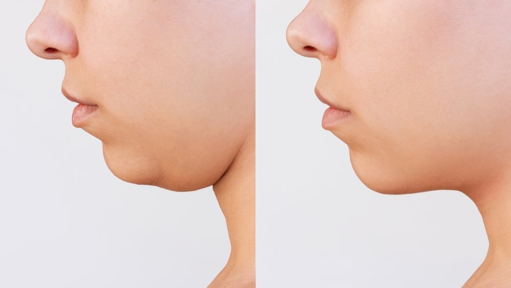 Liposuction,Of,The,Double,Chin.,Cropped,Shot,Of,Young,Woman’s